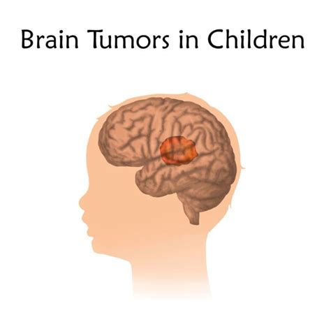Pediatric Brain Tumor Causes Symptoms And Treatment