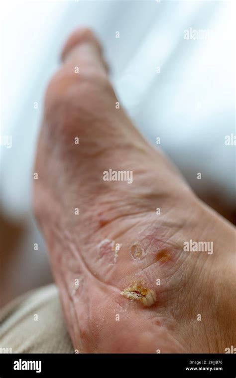 Foot Peeling Hi Res Stock Photography And Images Alamy
