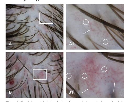 Figure 1 From Dermoscopic Findings In Psoriasis And Seborrheic