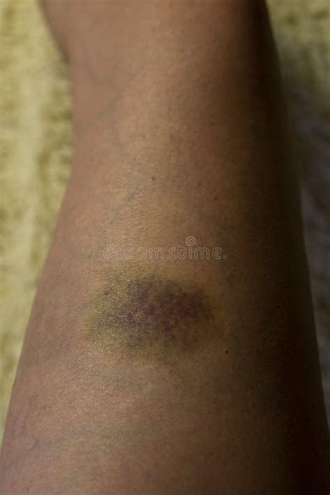 Blue And Yellow Bruise On His Leg Injury Stock Image Image Of