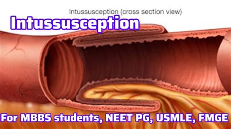 Intussusception For Mbbs Students Neet Pg Usmle Fmge I Neet Pg Usmle