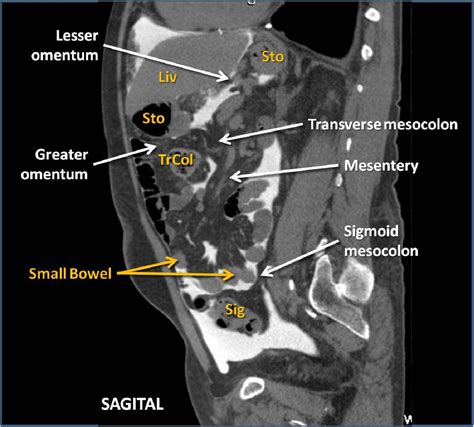 Figure 2 From Peritoneal Cavity Anatomy In Ct Peritoneography A