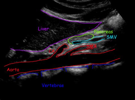 Abdominal Aorta Branches Abdominal Aorta Vascular Ultrasound Abdominal