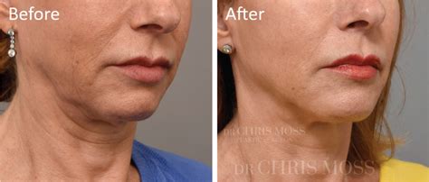 Neck Lift Before And After Results Dr Chris Moss Melbourne