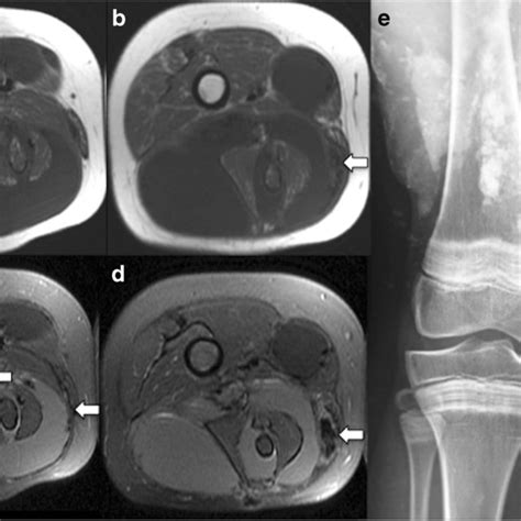 Thirty Six Year Old Man With Subacute Eosinophilic Fasciitis In The