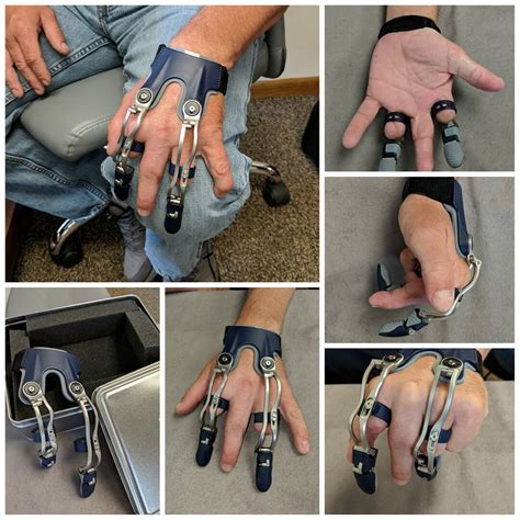 Finger Hand Photo Gallery Medical Art Prosthetics Orthotics And