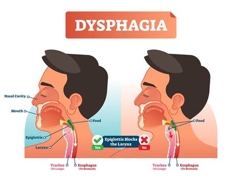 Swallowing And Strengthening Exercises For Dysphagia Home Heatlhcare
