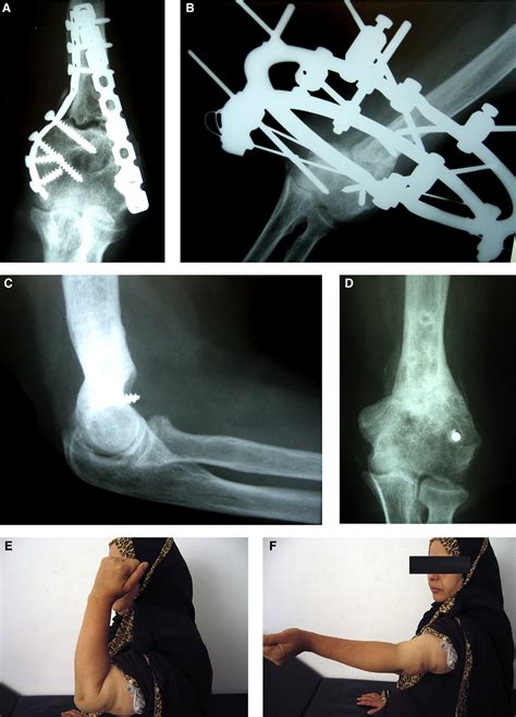 Pdf Treatment Of Post Infection Nonunion Of The Supracondylar Humerus