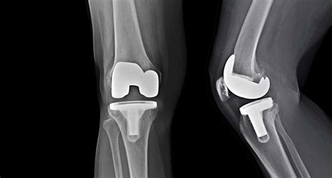 Exactech Knee Recall San Antonio Defective Medical Devices