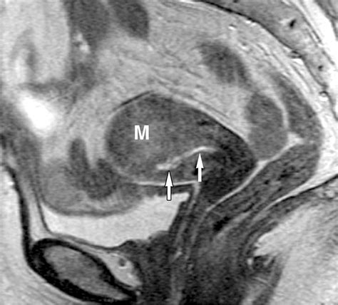 Diffusely Enlarged Uterus Evaluation With Mr Imaging Radiographics