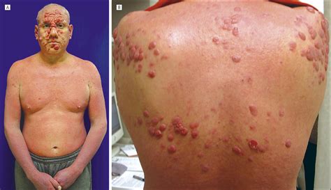 Progression Of Undiagnosed Cutaneous T Cell Lymphoma During Efalizumab