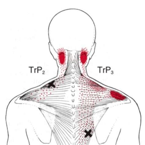 Trapezius Muscle Neck Pain