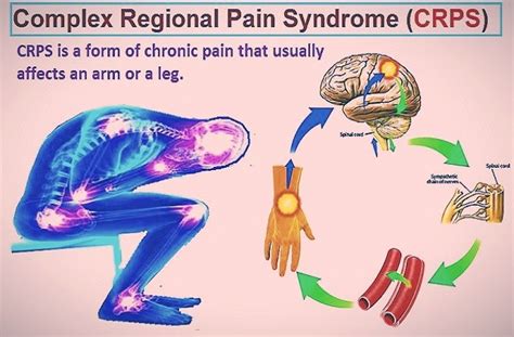 Complex Regional Pain Syndrome Crps Symptoms Causes And Treatment