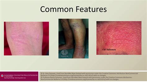 Treatment Of Moderate Severe Atopic Dermatitis Line 3 Stop 2 Features