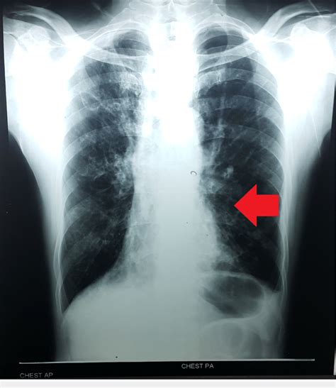 Cardiomegaly Chest X Ray