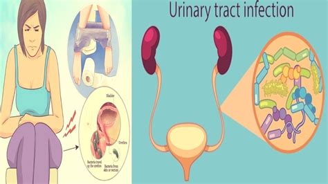 Ten Facts About Urinary Tract Infections In Women That Will Blow Your Mind Youtube