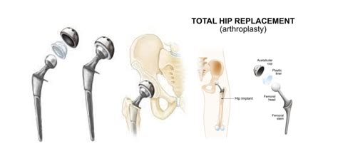 What Is Total Hip Arthroplasty Total Hip Replacement Best Physical
