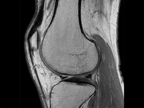 Knee Imaging With Cartilage Assessment Philips Mr Body Map