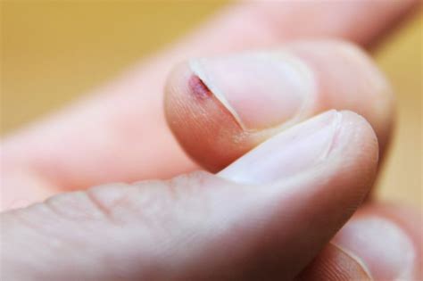 periungual wart under fingernail nail ftempo