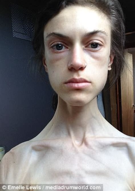 Instagram Saved My Life Anorexic Woman Wanted To Live Thanks To