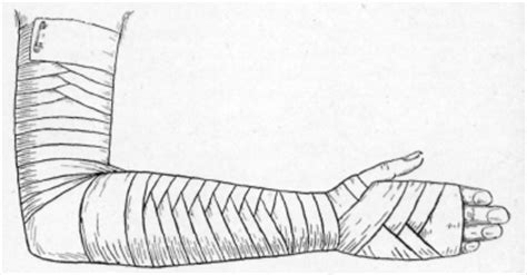 A bandage applied alternately to two parts, usually two segments of a limb above and below the joint, in such a way that the turns describe the figure 8. Bandaging: Arms