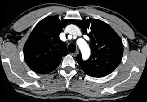 What Is The Reason For A Ct Scan With Contrast Ct Scan