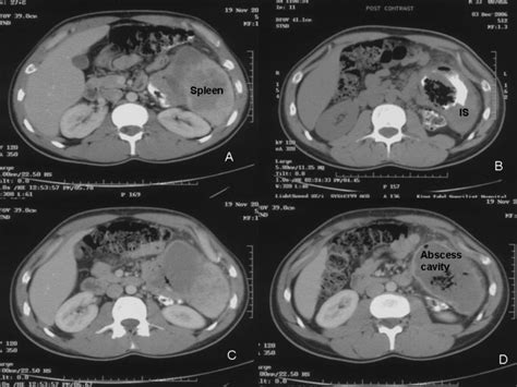 Ct Scan Of The Abdomen Showing What Looked Like Multiloculated Splenic