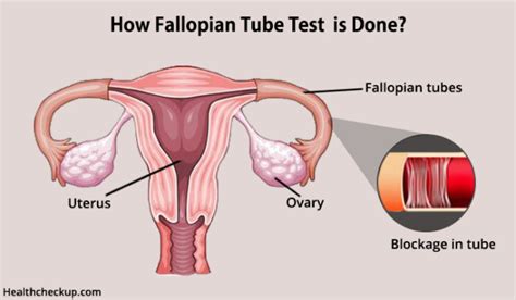 Blocked Fallopian Tube Test Blocked Fallopian Tubes Symptoms Causes