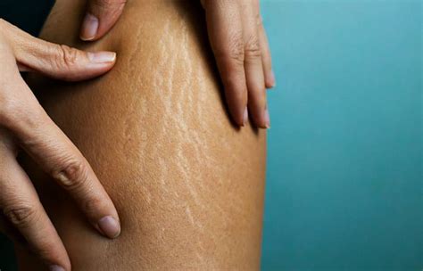 Stretch Marks Types Causes How To Manage And Reduce Them
