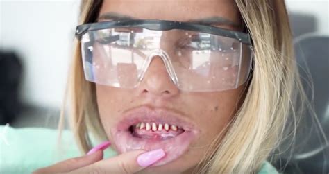 Katie Price Shows Off Real Teeth Ahead Of Veneer Replacement