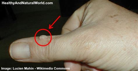 Warts On Hands Causes And Effective Natural Treatments