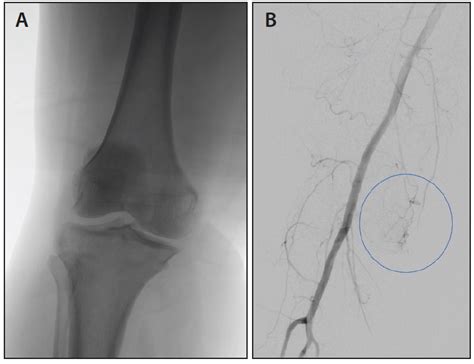 Genicular Artery Embolization To Treat Osteoarthritic Knee Pain