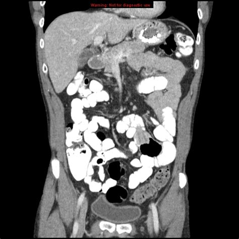 Small Bowel Intussusception Image