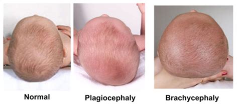 Artinya, bila diameter kepala bayi sekitar 30 cm, maka volume otak di dalamnya kemungkinan. Kepala Bayi Peyang, Berbahayakah bila dibiarkan ...