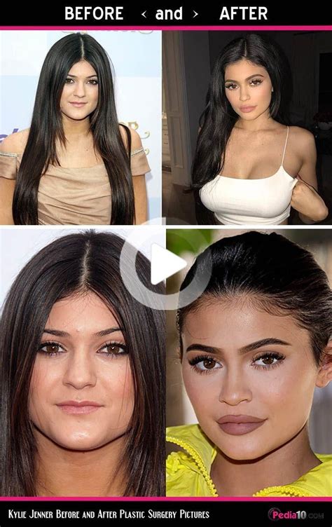 kylie jenner before and after plastic surgery pictures kylie jenner lips face plastic surgery