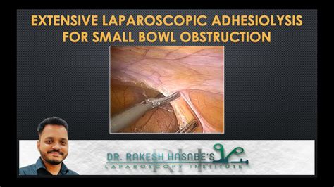 81 Extensive Laparoscopic Adhesiolysis For Small Bowel Obstruction