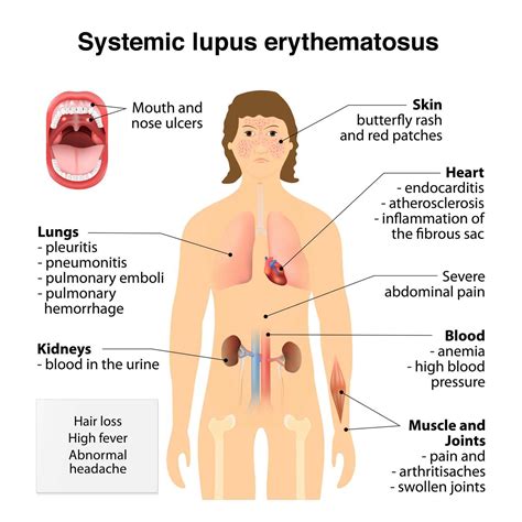 What Is Lupus What Causes Lupus Essential Oils For Lupus Lupus