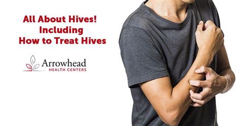 All About Hives Including How To Treat Hives Arrowhead Health Centers