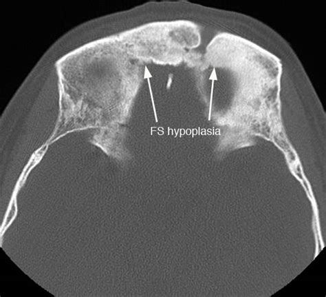 Ct Sinus Anatomy