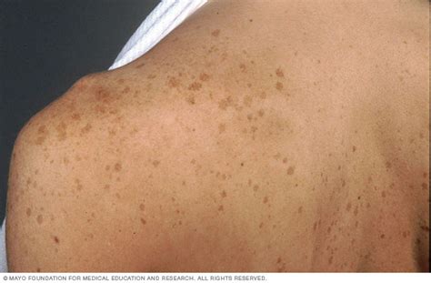 Age Spots Liver Spots Disease Reference Guide