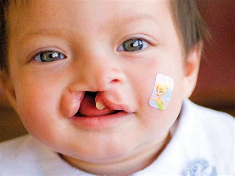 Importance Of Treating Cleft Lip And Palate As Soon As Possible Wide