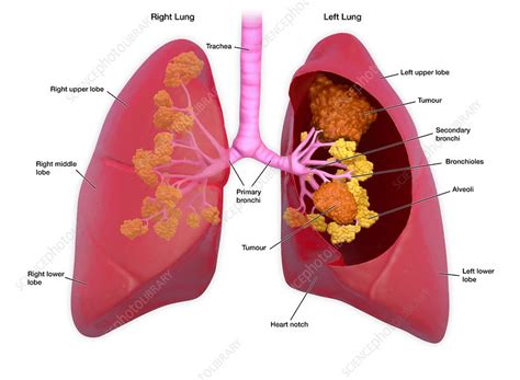 lung cancer illustration stock image f032 4740 science photo library