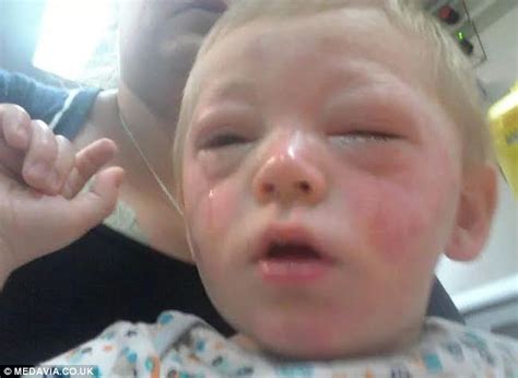 Toddler Allergic To Tomatoes Nearly Died After Sticking His Finger In