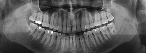 Dental X Rays Mark Osmond Dental Clinic