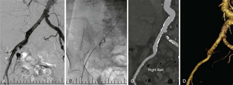 Imaging Guidance Of Transcatheter Valve Procedures Thoracic Key