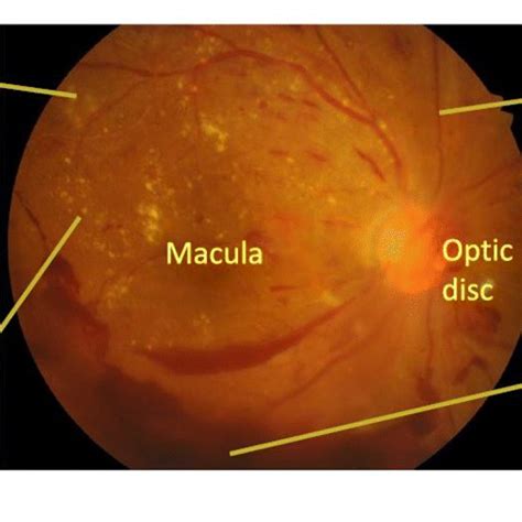 Retinal Scan Image Representing Various Lesions Developed In Retina Of