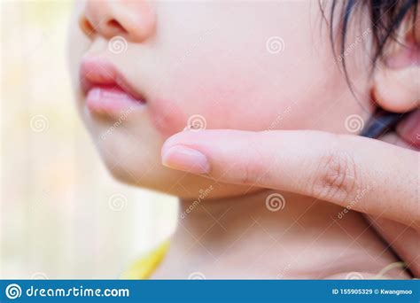 Mother Applying Topical Antihistamine Cream At Kid Face With Skin Rash