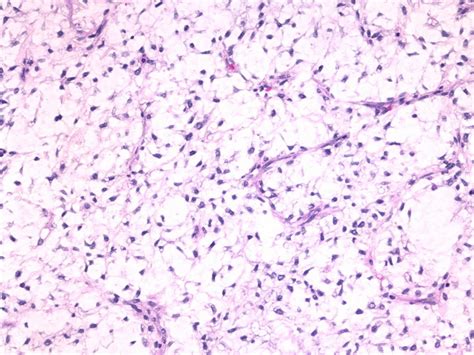 Lipoma Vs Liposarcoma Histology