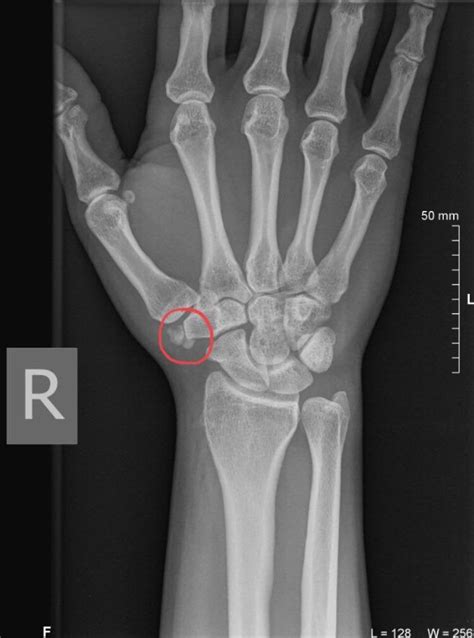So I Just Found Out I Have Two Extra Bones In My Wrist That Shouldnt