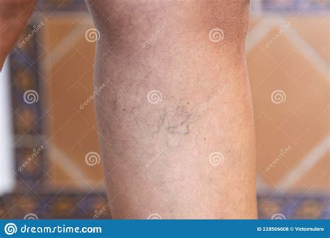Adult Womanand X27s Leg With Varicose Veins Stock Photo Image Of Human